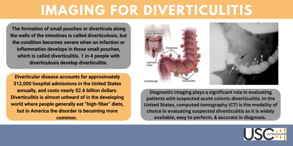 Diverticulitis Infographic